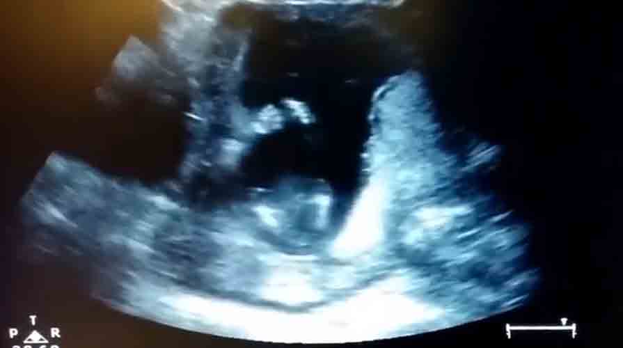 Clapping in the womb!