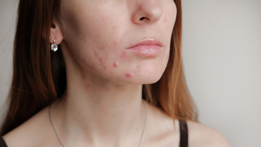 What Can I do About Mask Acne?