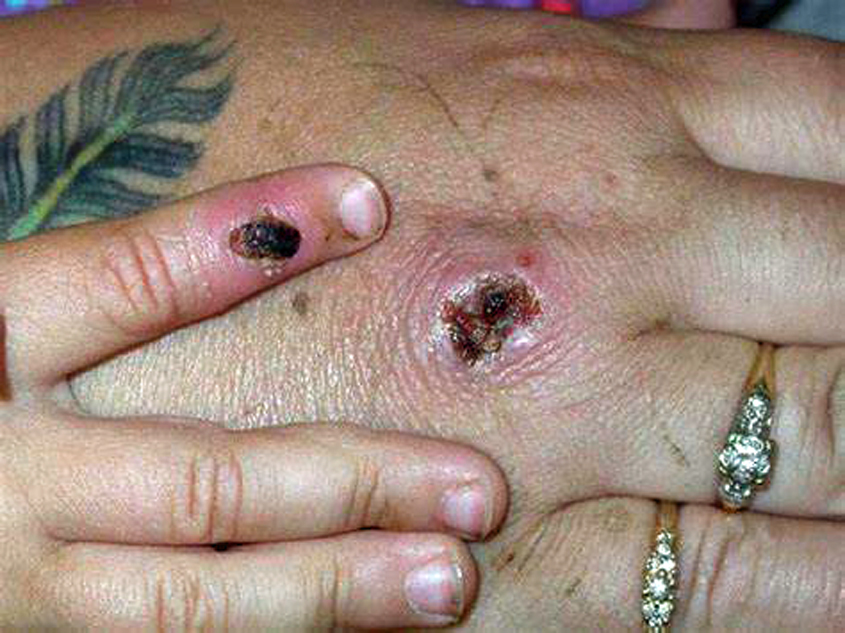 First Monkeypox Case Identified in Mississippi